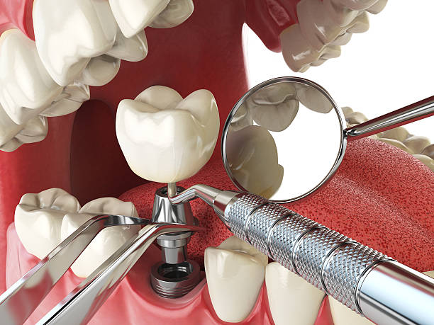 Best Urgent Care for Lost Fillings or Crowns in Toona, AL